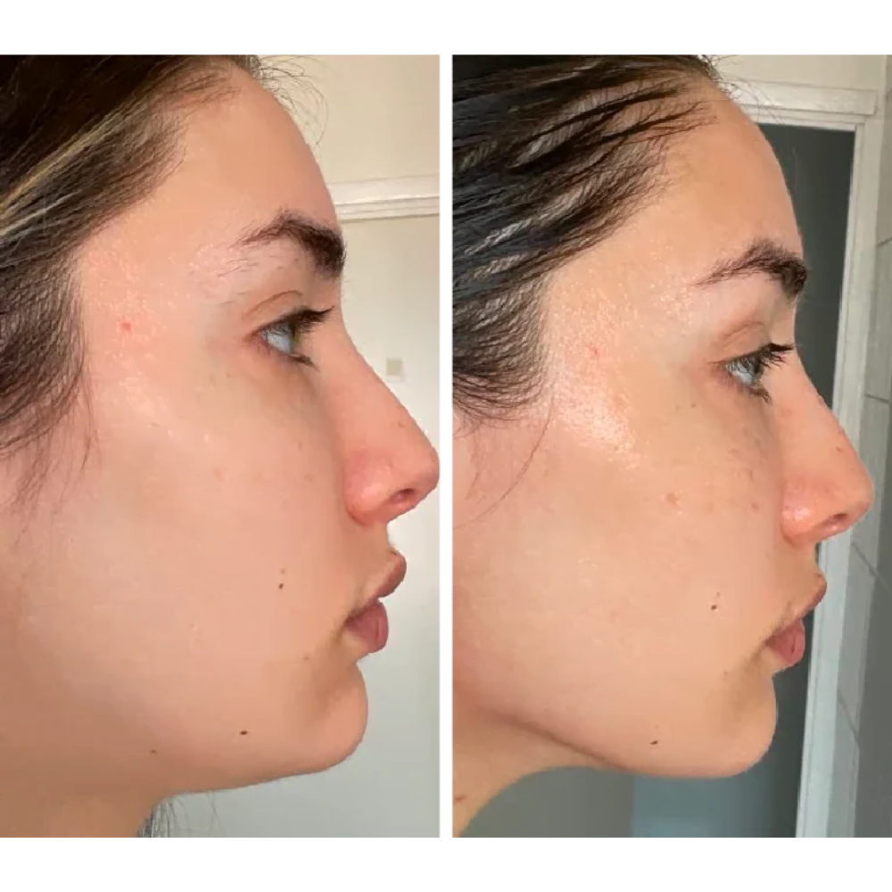 Lumé - EMS Face & Neck Lifter